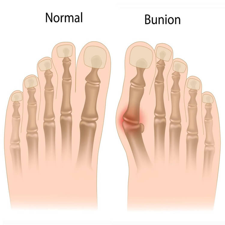 2 PCS Hallux Valgus Correction Bandage Toe Spreader Toe Correction Hallux Valgus Track Bale Guard