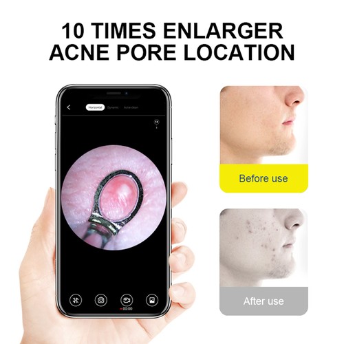 SUNUO X8 Smart Visual Ear Cleaner, Acne Squeezing, 5MP HD-kamera, 6-axligt gyroskop, silikon öronspetsar, WiFi-anslutning